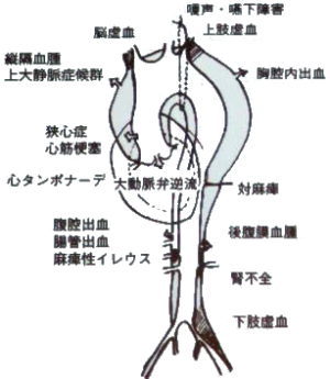 大動脈解離出現箇所