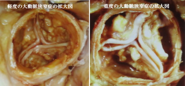 大動脈狭窄症生